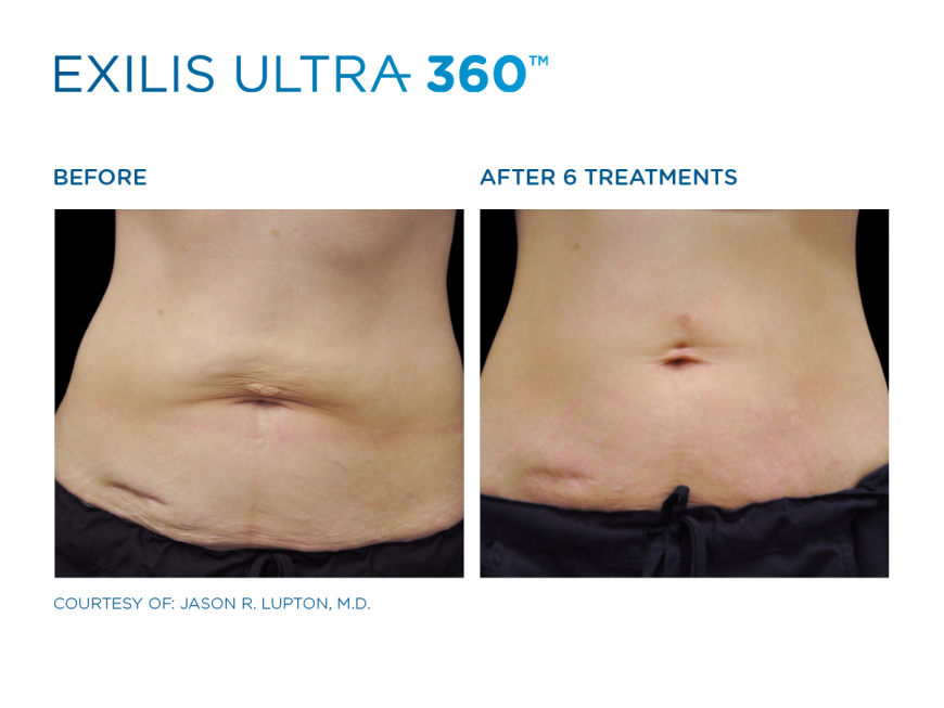 BTL Exilis treatment in Dubai BTL Exilis treatment in Dubai